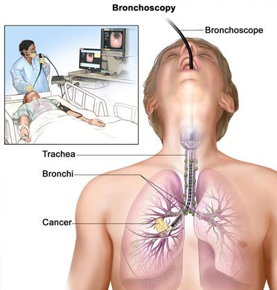 Bronchoscopy Treatments